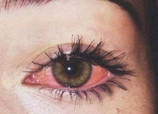Why do we Get Red Eyes After Smoking Weed